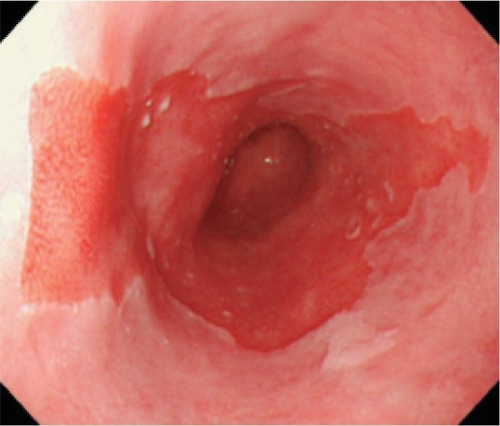 Endoscopic view of Barrett's esophagus showing abnormal salmon-colored mucosa